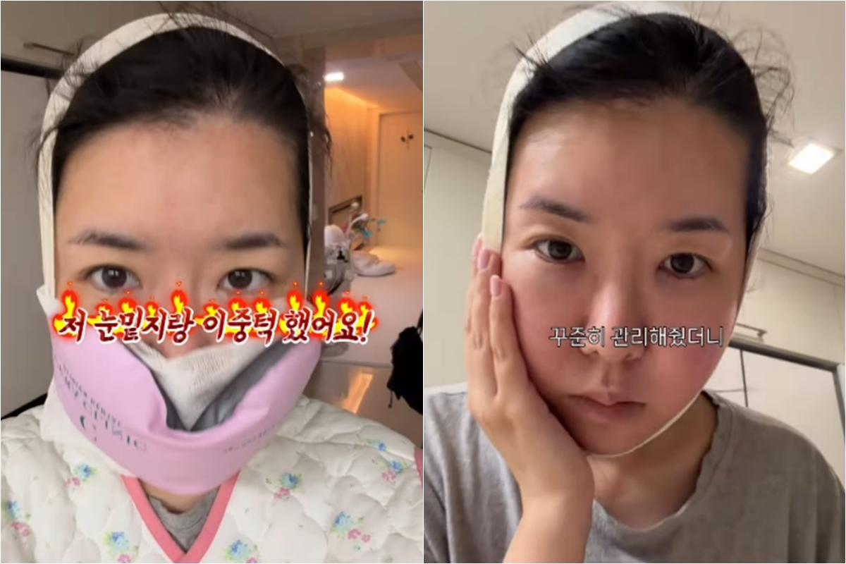 '최성욱♥' 김지혜, 눈밑지→이중턱 수술 마쳤다...붕대 칭칭 비주얼 [MH... - 뉴스 썸네일 이미지