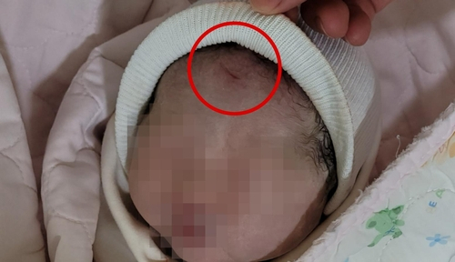 제왕절개 하다 아이 이마에 칼자국…의사는 '눌린 자국 같다'