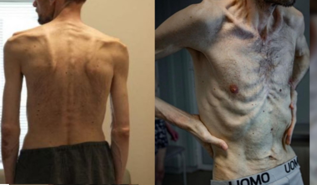 뼈만 남은 앙상한 몸 …‘러시아 포로’였던 우크라 남성에게 무슨 일이
