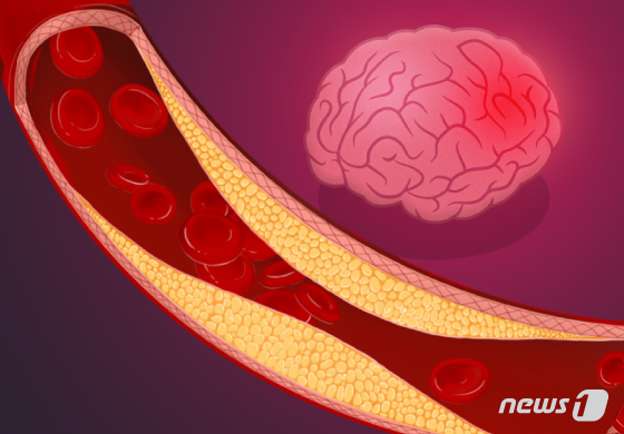 A cerebral aneurysm occurs when a portion of an artery in the brain bulges like a balloon or pouch. © News1 DB