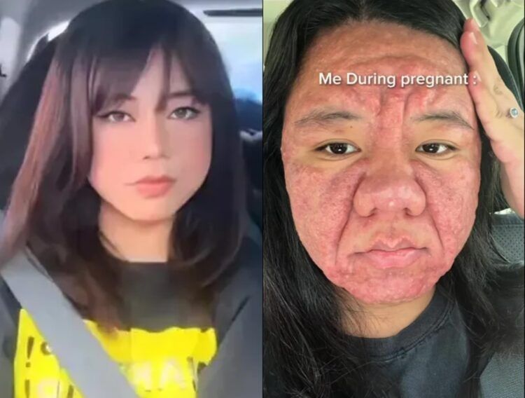 マレーシア出身のファラ・ファイザルという女性は、自身のTikTokアカウントで妊娠後に悪化した顔の変化により深刻な精神的ストレスを受けたと告白した。[写真＝ファラ・ファイザルTikTok]]