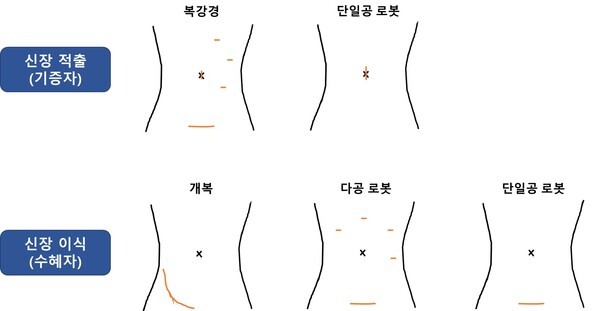[그림] 수술 방법에 따른 기증자(신장 적출) 및 수혜자(신장이식) 절개 위치 비교