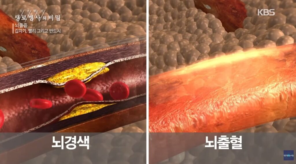 뇌졸중