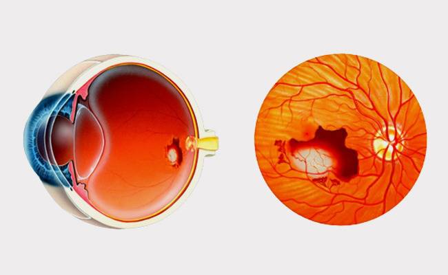 황반변성