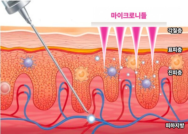 주사 버리고 ‘붙였다’… 알레르기 면역치료 판을 뒤집은 라파스
