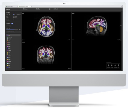 Demonstration of Neurophet AQUA, an AI-based brain disease diagnostic assistance software developed by Neurophet (Provided by Neurophet) / News1
