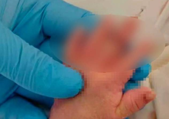 중국의 한 병원에서 제왕절개 분만 과정 중 의료진의 실수로 신생아의 손가락 일부가 절단되는 사고가 발생해 충격을 주고 있다. 사진=엑스