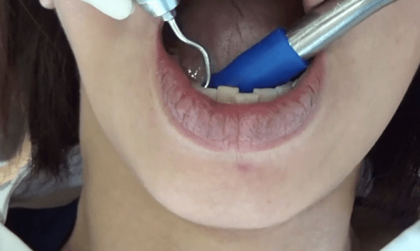 *Dental TV*マウスピース矯正歯科医Taka