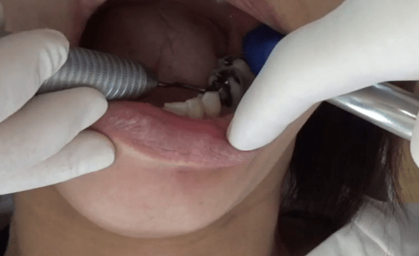 *Dental TV*マウスピース矯正歯科医Taka