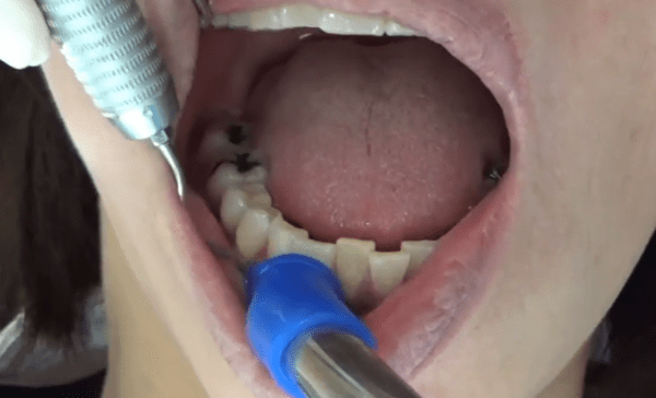 *Dental TV*マウスピース矯正歯科医Taka