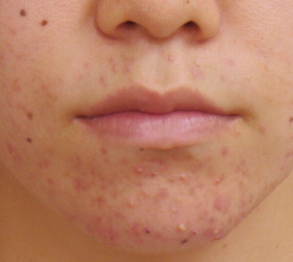 adultpimple