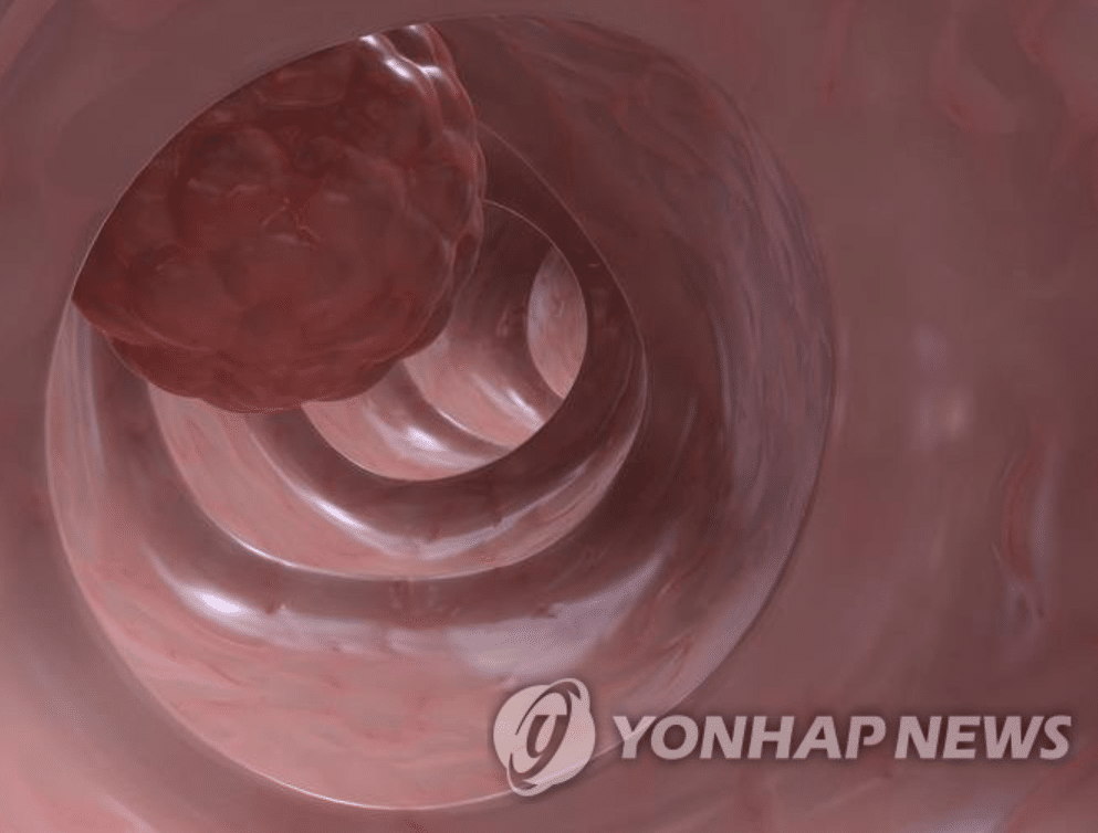 치매 걸릴 확률 11% 낮다…15년 연구 끝에 밝혀진 충격 메커니즘 4 암 알츠하이머 관계