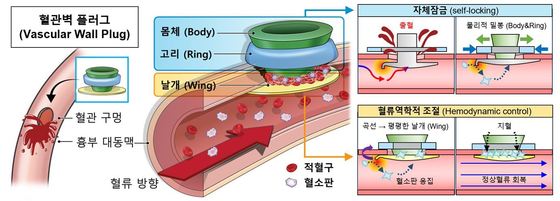Overview of the Vascular Wall Plug Developed by the Research Team / Provided by Severance Hospital