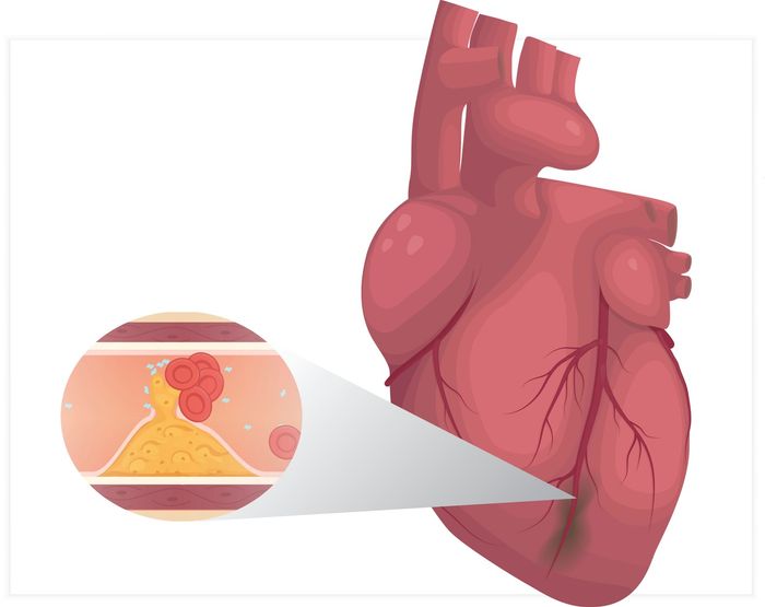 심근경색 관련 이미지. ⓒ서울대병원