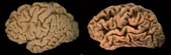(왼쪽부터) 정상적인 뇌, 알츠하이머병 환자의 뇌 ⓒ서울대병원