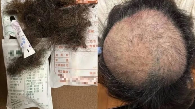 악취로 인한 스트레스로 탈모가 생겼다고 주장하며 게시한 사진. 사진=SNS 캡처