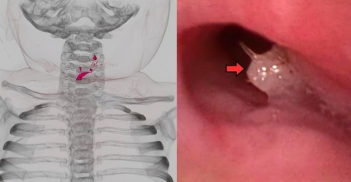 살아 있는 물고기를 삼킨 7개월 아기의 CT 검사에서 목 부위 이물질(빨간색)이 보이는 모습. 오른쪽 사진은 내시경 검사를 통해 이물질이 확인된 모습. 사진=Trauma & Case Reports, 코메디닷컴