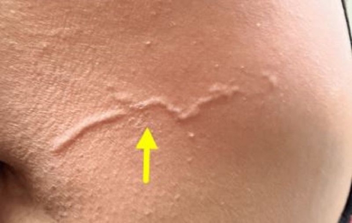 40대 여성 등에 나타난 피부 유충 이행증 병변. 사진=큐레우스