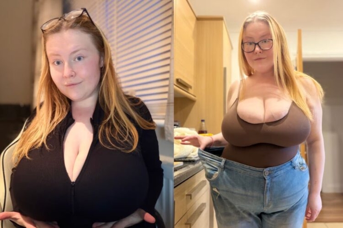 체중 감량 주사로 살은 빠졌지만 오히려 유방이 커지면서 희귀 질환 사실을 알게된 여성. 사진=티아나 SNS 캡처