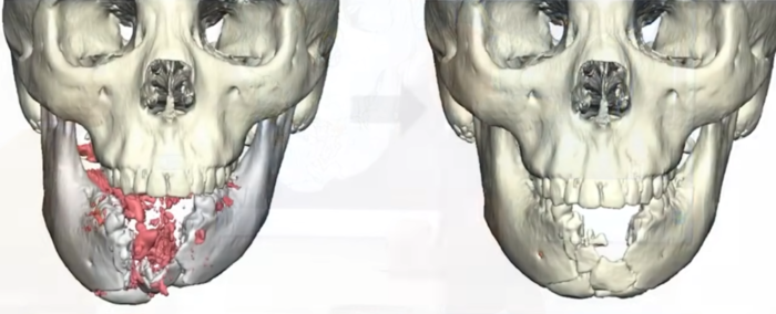 총격으로 턱뼈를 잃고 3D 프린팅 보형물을 이식받은 미국 아이오와주 고등학생 미야 부이의 CT 스캔 이미지. 사진=KCCI 캡처