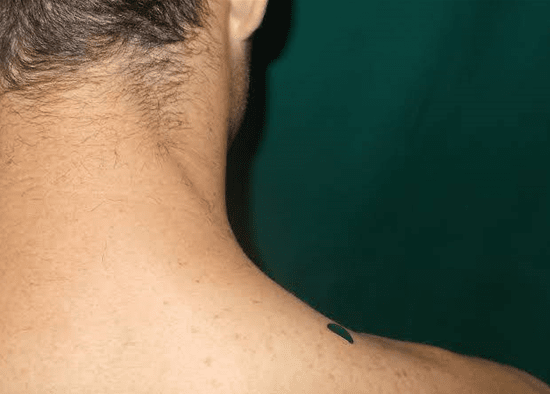 acupressure