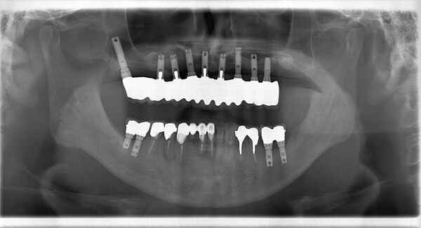 the-implant