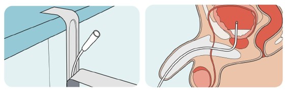 Clean intermittent catheterization, where patients with neurogenic bladder insert a disposable catheter into the bladder to empty it / Provided by Seoul St. Mary\'s Hospital