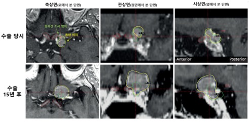 MRI images of a 55-year-old female patient showing the area adjacent to the optic nerve at the time of surgery (top) and 15 years later (bottom). Although radiation was not administered to part of the tumor at the time of surgery to protect the optic nerve, the tumor regrew 15 years later in the area that had previously been spared from radiation / Provided by Seoul National University Hospital
