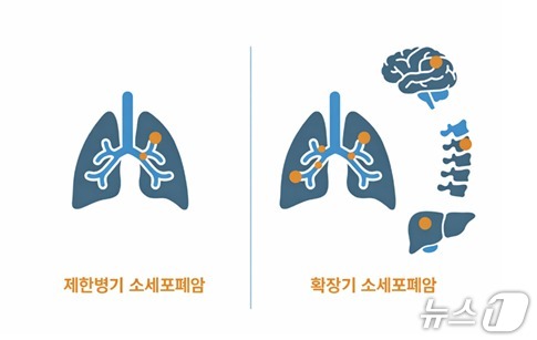 Small cell lung cancer is classified into two stages based on the extent of disease progression. The limited-stage disease refers to a condition in which the cancer is confined to one side of the chest and adjacent lymph nodes and can be treated with radiation therapy; this accounts for approximately 30% of all small cell lung cancer patients.