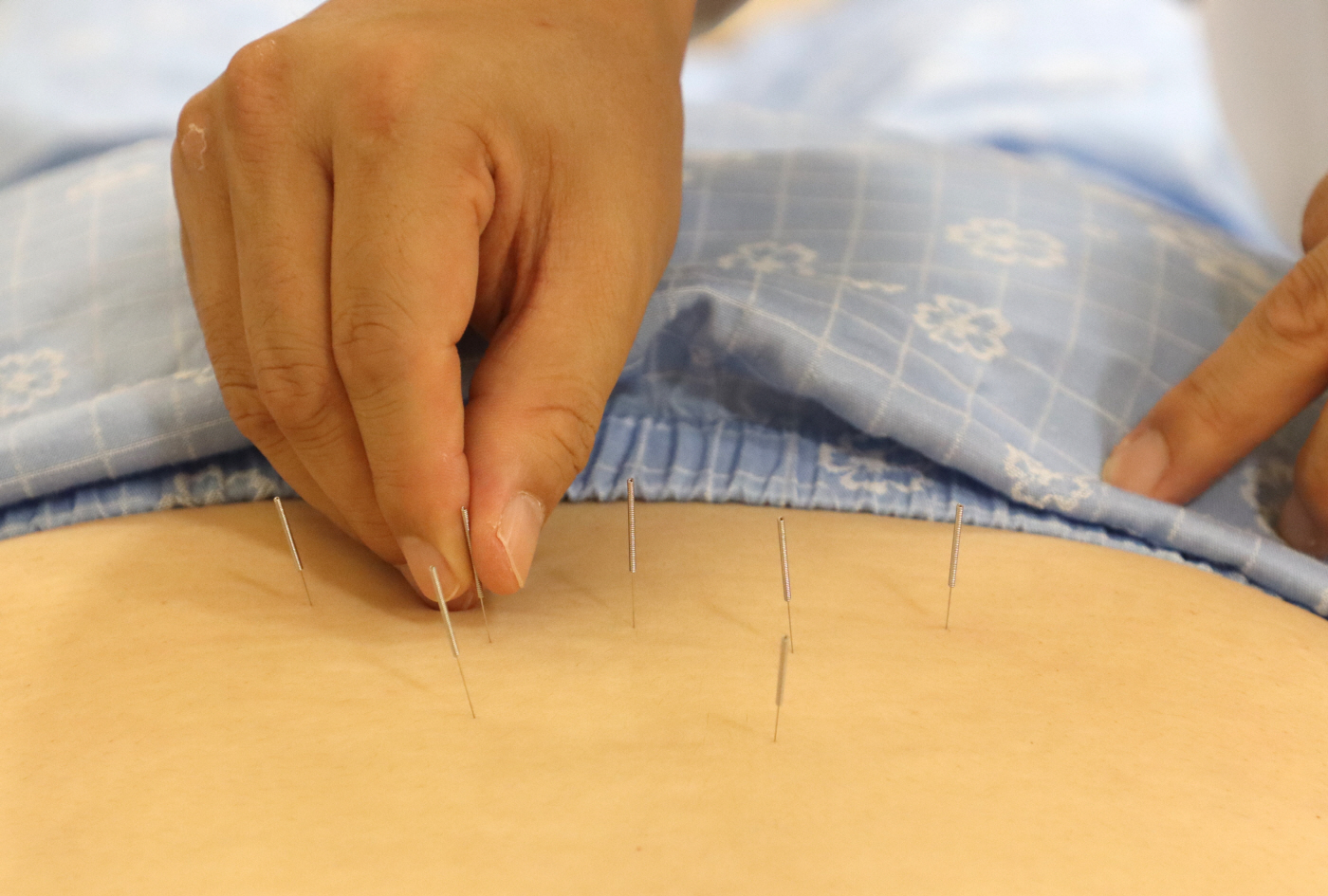 [사진설명] 자생한방병원 의료진이 허리 통증을 호소하는 환자에게 침 치료를 실시하고 있다 (출처  자생한방병원)