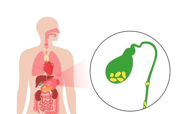 담석증 이미지 ⓒ게티이미지뱅크