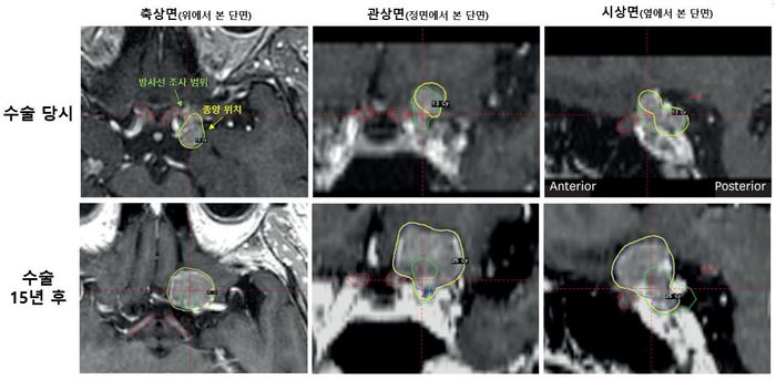 55세 여성 환자의 시신경 인접 수막종 수술 당시(상단)와 15년 후(하단) MRI 영상 ⓒ서울대병원