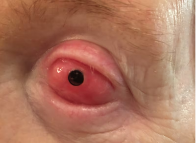 '골치아각막보철술'(OOKP)을 받아 붉은색을 띠는 눈. 사진=그렉 몰로니 박사