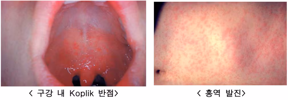 홍역은 급성 발진성 바이러스 질환으로 전염성이 매우 높다. 홍역에 걸리면 초기에 감기처럼 기침, 콧물, 결막염 등의 증상이 나타나고, 고열과 함께 얼굴에서 시작해서 온몸에 발진이 나타난다. 