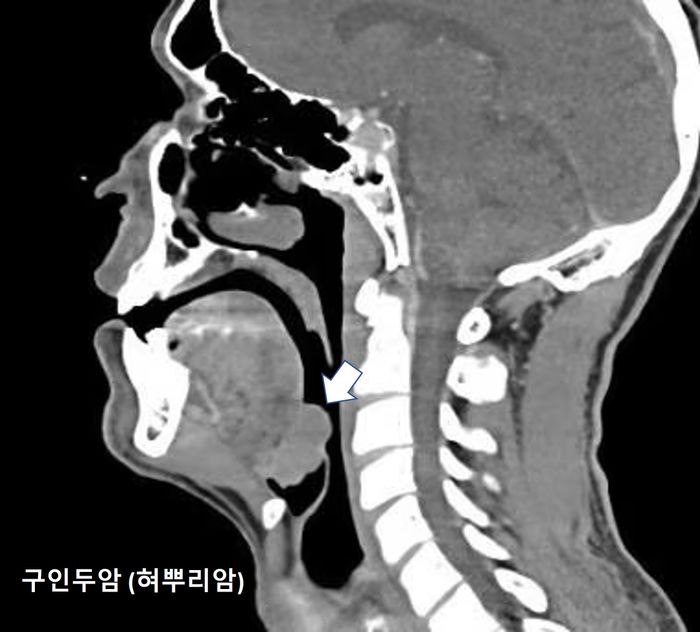 구인두암(혀뿌리암) CT 검사 사진 ⓒ가톨릭대 서울성모병원