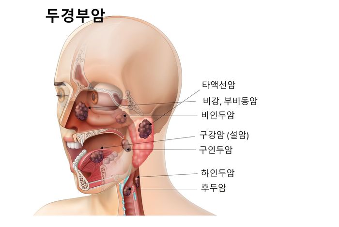 두경부암 설명 이미지 ⓒ가톨릭대 서울성모병원