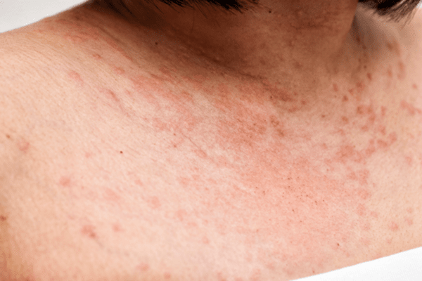 hiroshima-derma