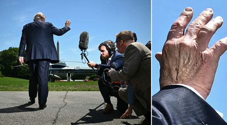 Donald Trump spotted with giant hole in his hand sparking serious health concerns / Credit: X