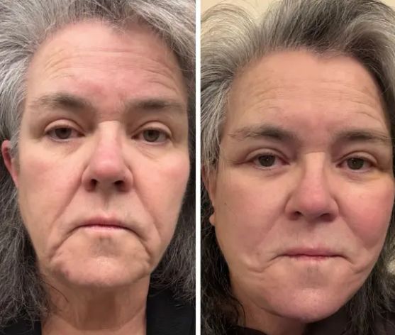 Rosie O\'Donnell\'s Before and After Pictures / Credit: X